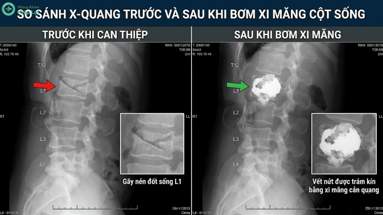 Chi Phí Bơm Xi Măng Cột Sống Giá Bao Nhiêu? Giải Đáp Chi Tiết Từ Chuyên Gia - Phòng khám Hiệp Lợi