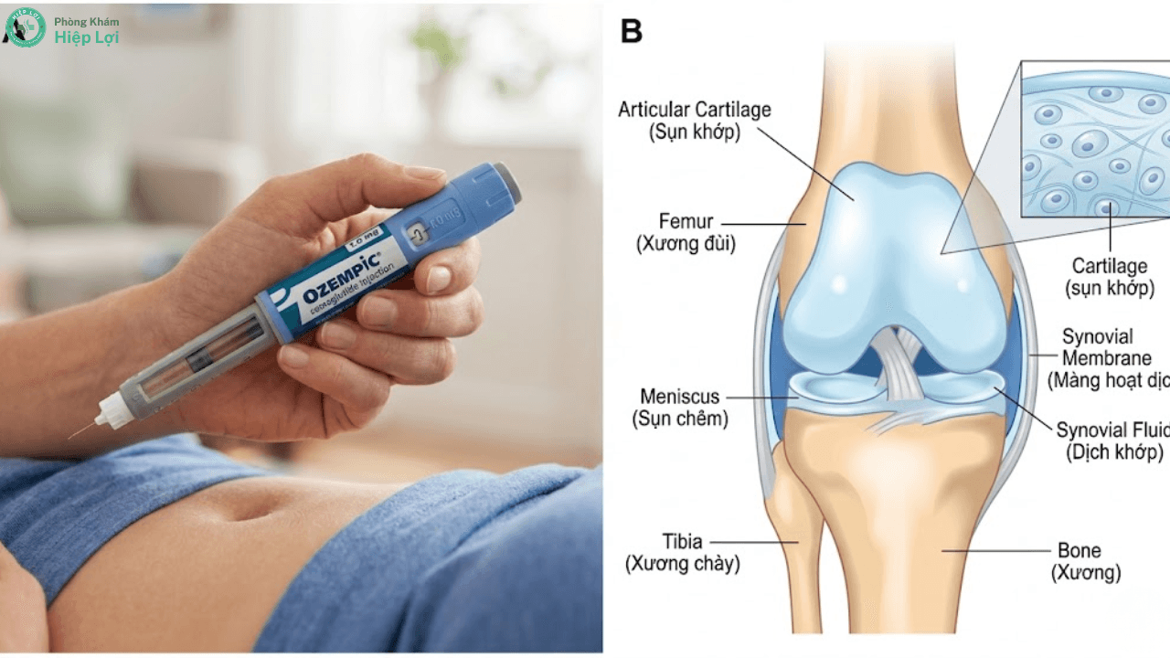 Đột Phá Kép: Thuốc GLP-1 Vừa Mang Lợi Ích Vừa Gây Rủi Ro Cho Xương Khớp