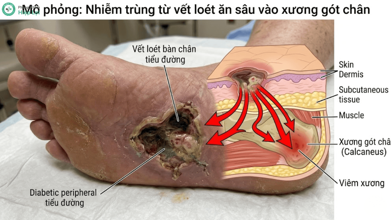 Viêm Tủy Xương: Dấu Hiệu Cảnh Báo & Phác Đồ Điều Trị - Phòng khám Hiệp Lợi