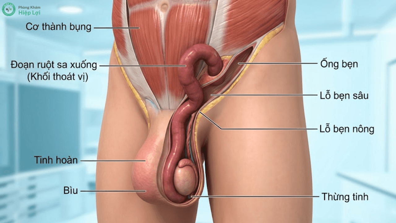 Thoát Vị Bẹn: Dấu Hiệu Cảnh Báo & Phương Pháp Điều Trị