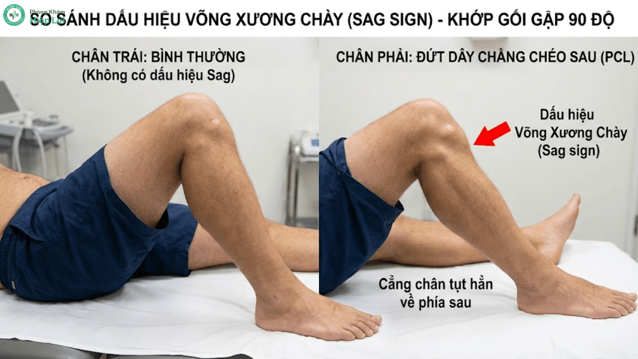 6 Dấu Hiệu Đứt Dây Chằng Chéo Sau: Cảnh Báo Nguy Cơ Tàn Phế Khớp Gối - Phòng khám Hiệp Lợi