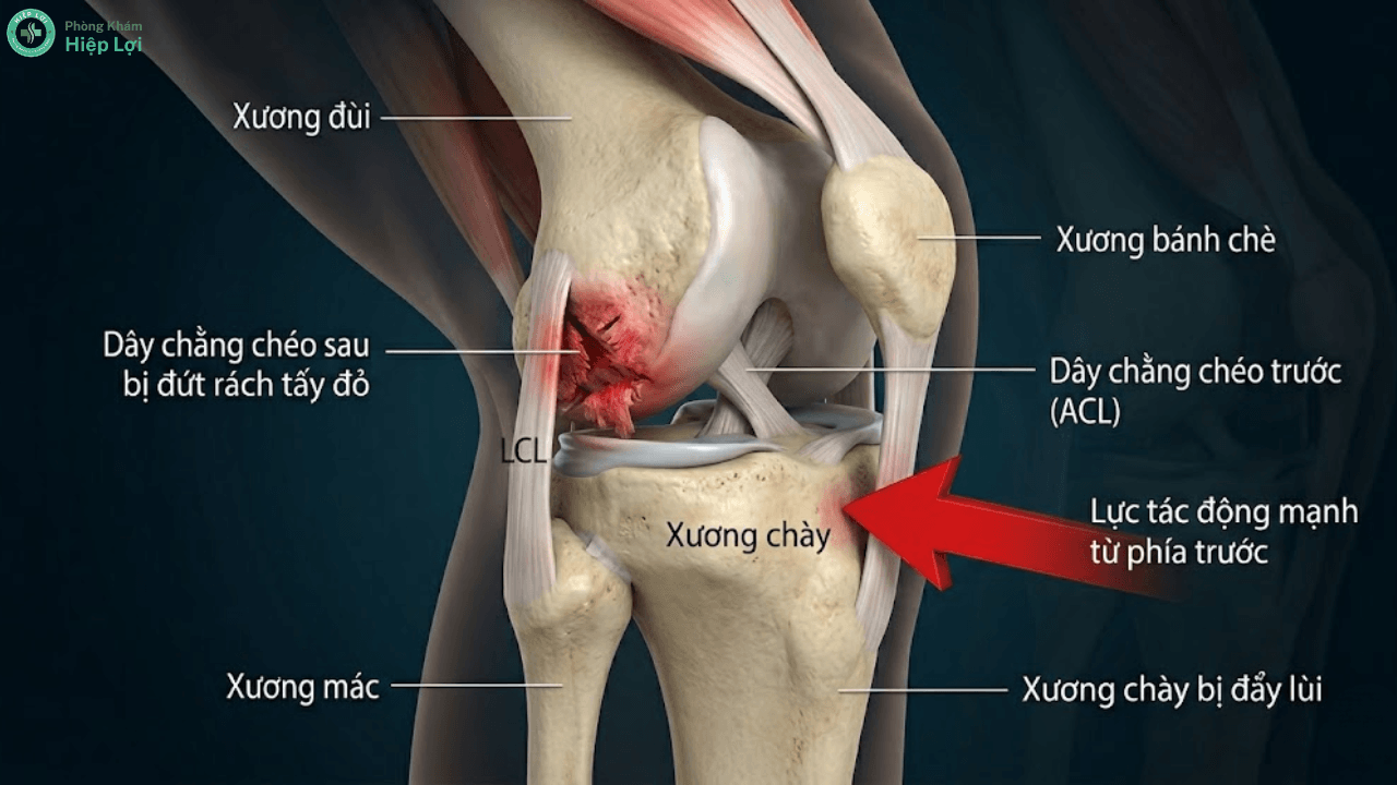 6 Dấu Hiệu Đứt Dây Chằng Chéo Sau: Cảnh Báo Nguy Cơ Tàn Phế Khớp Gối