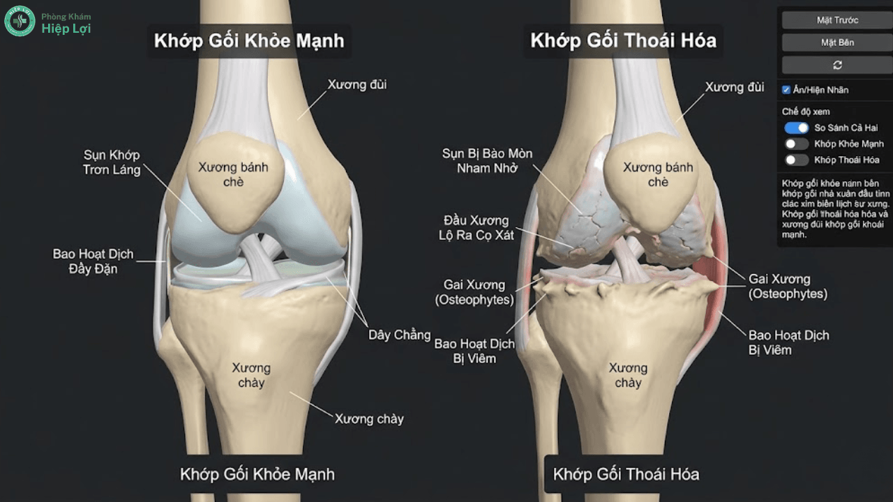 Viêm Xương Khớp (Osteoarthritis): Nhận Diện "Kẻ Thù" Của Tuổi Tác Và Phác Đồ Phục Hồi