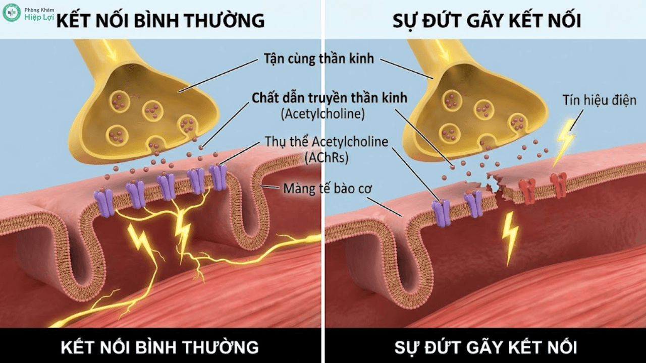 Hội Chứng Nhược Cơ Có Chữa Được Không? Giải Đáp Tiên Lượng Sống Và Cách Điều Trị