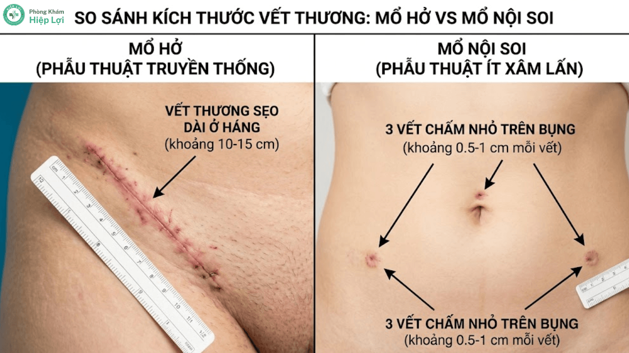 Phẫu Thuật Thoát Vị Bẹn: Đánh Giá Các Phương Pháp Và Cách Phục Hồi - Phòng khám Hiệp Lợi