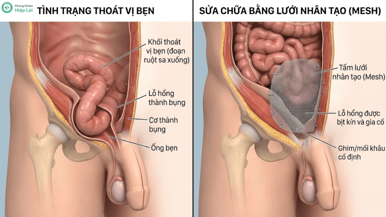 Phẫu Thuật Thoát Vị Bẹn: Đánh Giá Các Phương Pháp Và Cách Phục Hồi