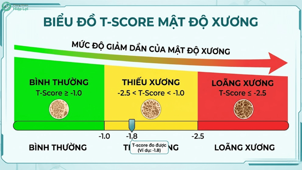 Xét Nghiệm Mật Độ Xương Là Gì? Ai Cần Phải Tầm Soát Ngay Lập Tức? - Phòng khám Hiệp Lợi