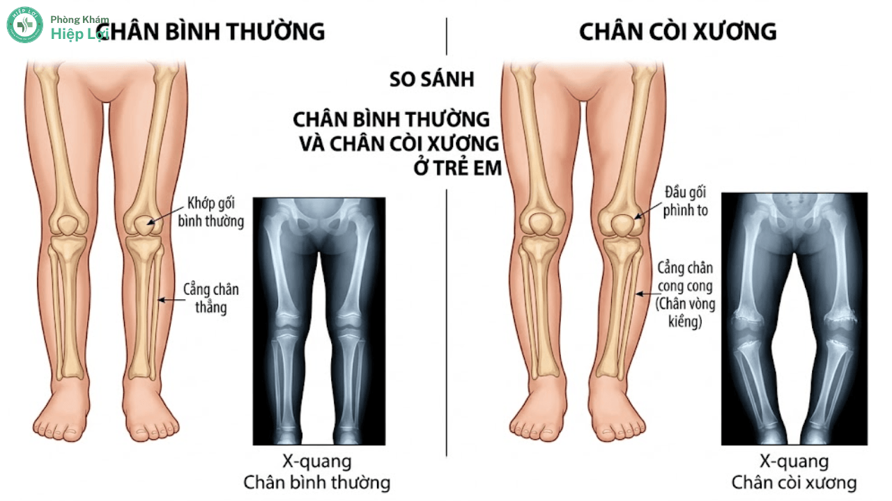 Chân Vòng Kiềng Ở Trẻ: Nguyên Nhân, Cách Kiểm Tra Và Hướng Khắc Phục Sớm - Phòng khám Hiệp Lợi