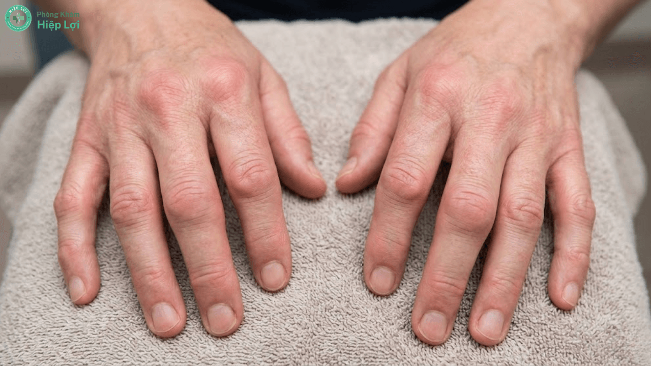 Giải Đáp Từ Bác Sĩ: Sưng Tấy Các Khớp Là Dấu Hiệu Bệnh Gì Và Cách Xử Lý - Phòng khám Hiệp Lợi