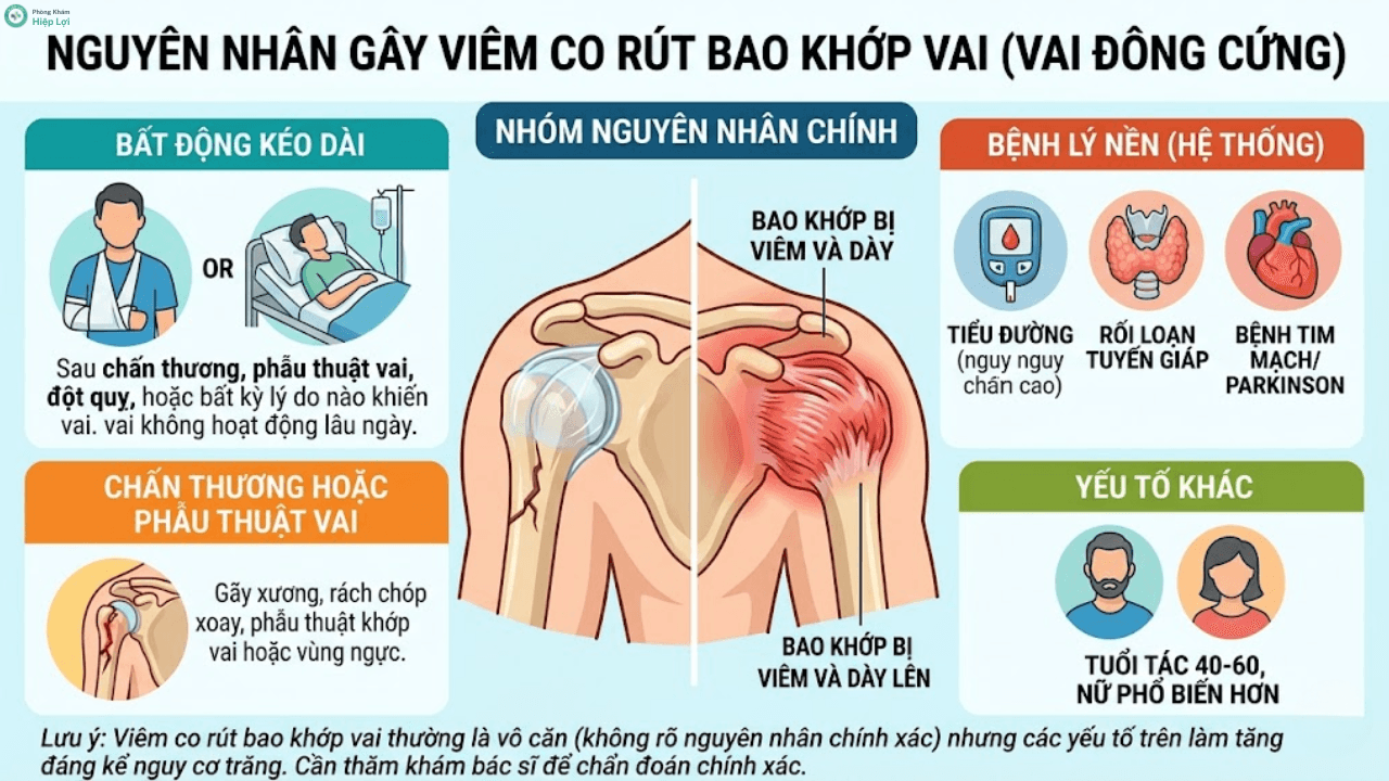 Diễn Biến Của Bệnh Viêm Co Rút Bao Khớp Vai (Đông Đặc Khớp Vai) Và Cách Điều Trị - Phòng khám Hiệp Lợi