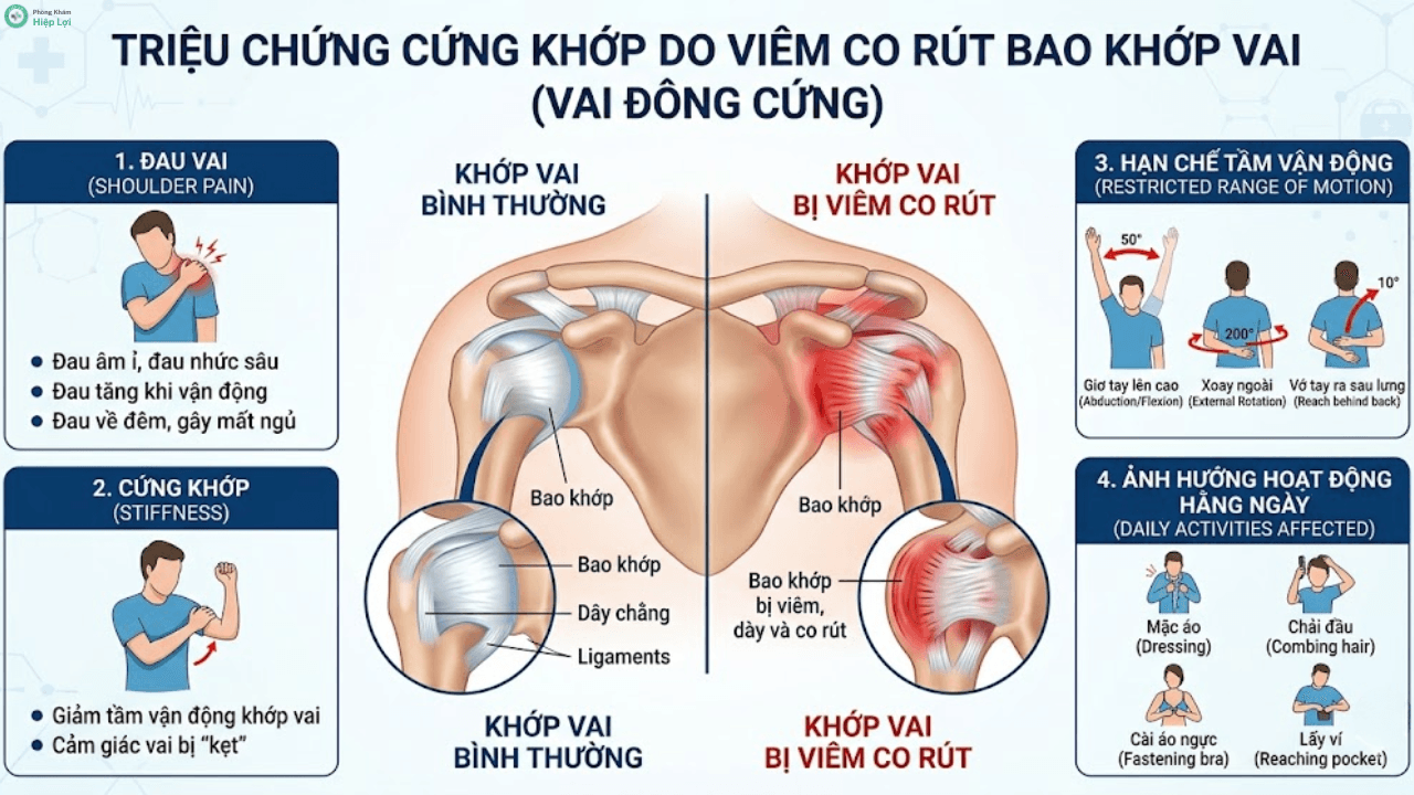 Diễn Biến Của Bệnh Viêm Co Rút Bao Khớp Vai (Đông Đặc Khớp Vai) Và Cách Điều Trị - Phòng khám Hiệp Lợi