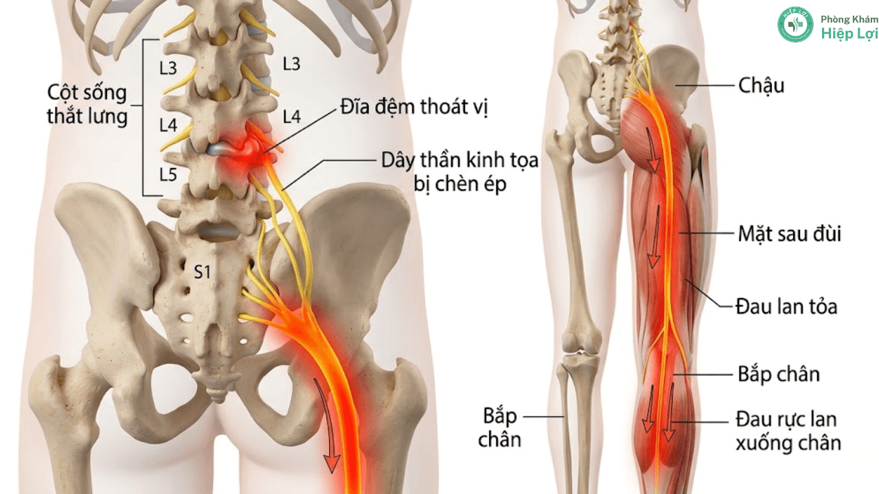Châm Cứu Đau Thần Kinh Tọa Có Thực Sự Hiệu Quả Không? Giải Đáp Từ Chuyên Gia
