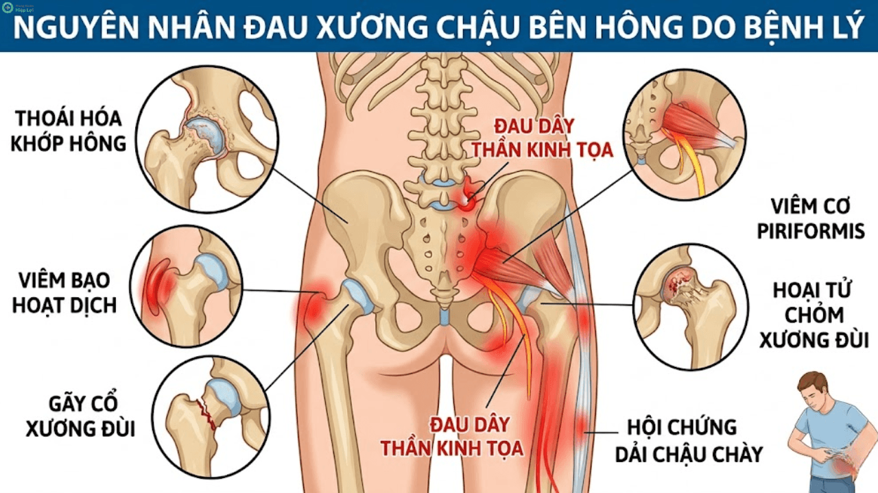 Đau Xương Chậu Bên Hông Là Bệnh Gì? Giải Mã Nguyên Nhân & Cách Điều Trị Hiệu Quả - Phòng khám Hiệp Lợi