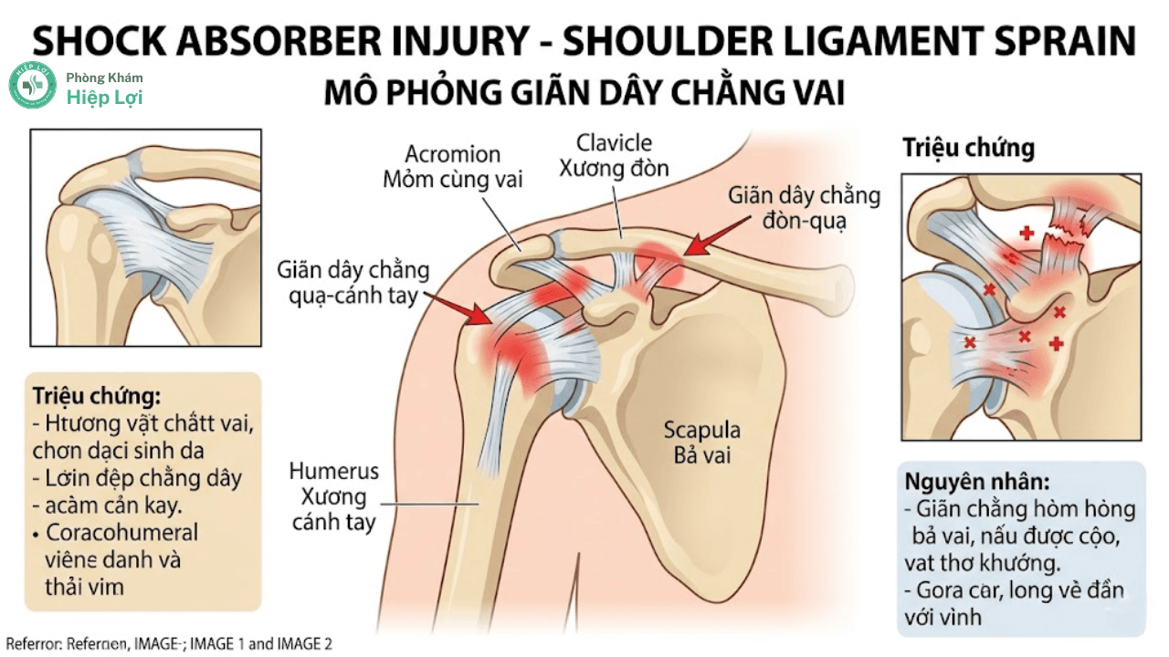 Giãn Dây Chằng Vai: Nguyên Nhân, Triệu Chứng Và Cách Xử Lý - Phòng khám Hiệp Lợi