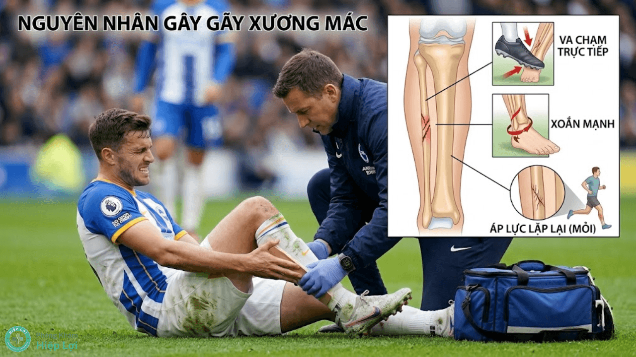Bác Sĩ Trả Lời: Gãy Xương Mác Phải Bó Bột Bao Lâu Thì Lành Và Đi Lại Được? - Phòng khám Hiệp Lợi