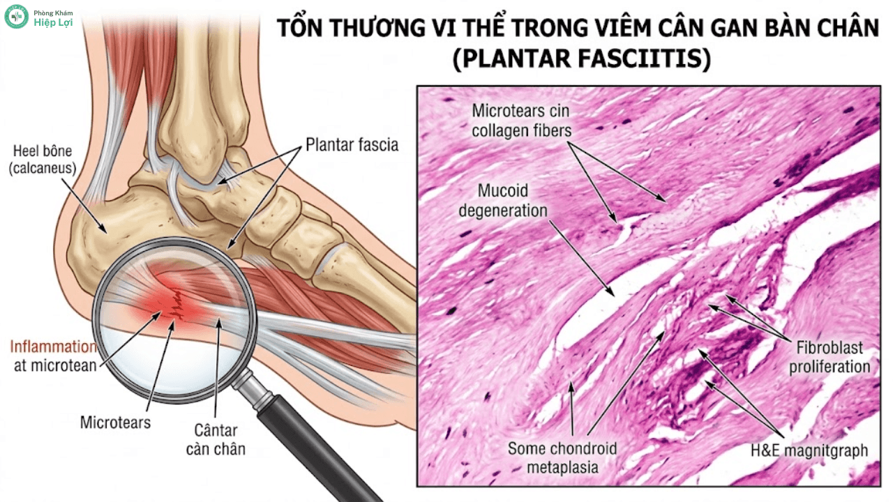Hiểu Đúng Về Bệnh Viêm Cân Gan Bàn Chân Và Cách Điều Trị - Phòng khám Hiệp Lợi