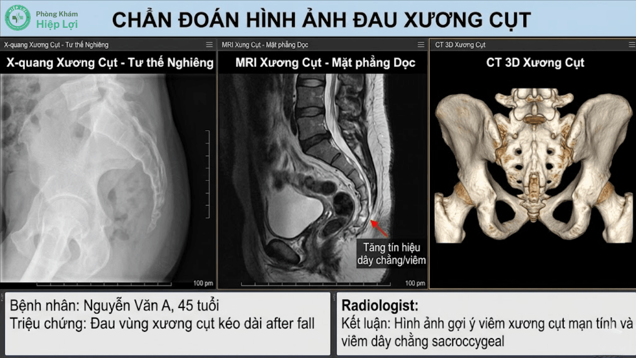 Đau Xương Cụt Là Bệnh Gì? Nguyên Nhân Cốt Lõi Và Cách Điều Trị - Phòng khám Hiệp Lợi