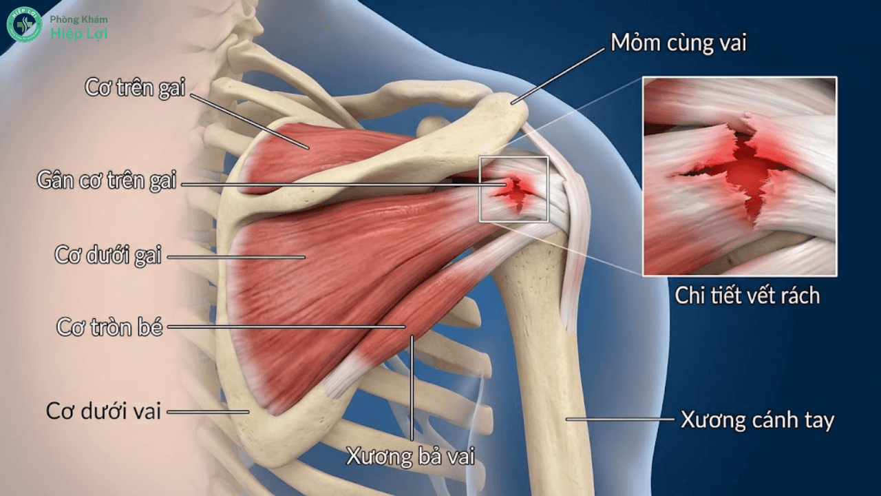 Rách Cơ Chóp Xoay Là Gì? Nguyên Nhân, Triệu Chứng Và Cách Điều Trị Hiệu Quả - Phòng khám Hiệp Lợi
