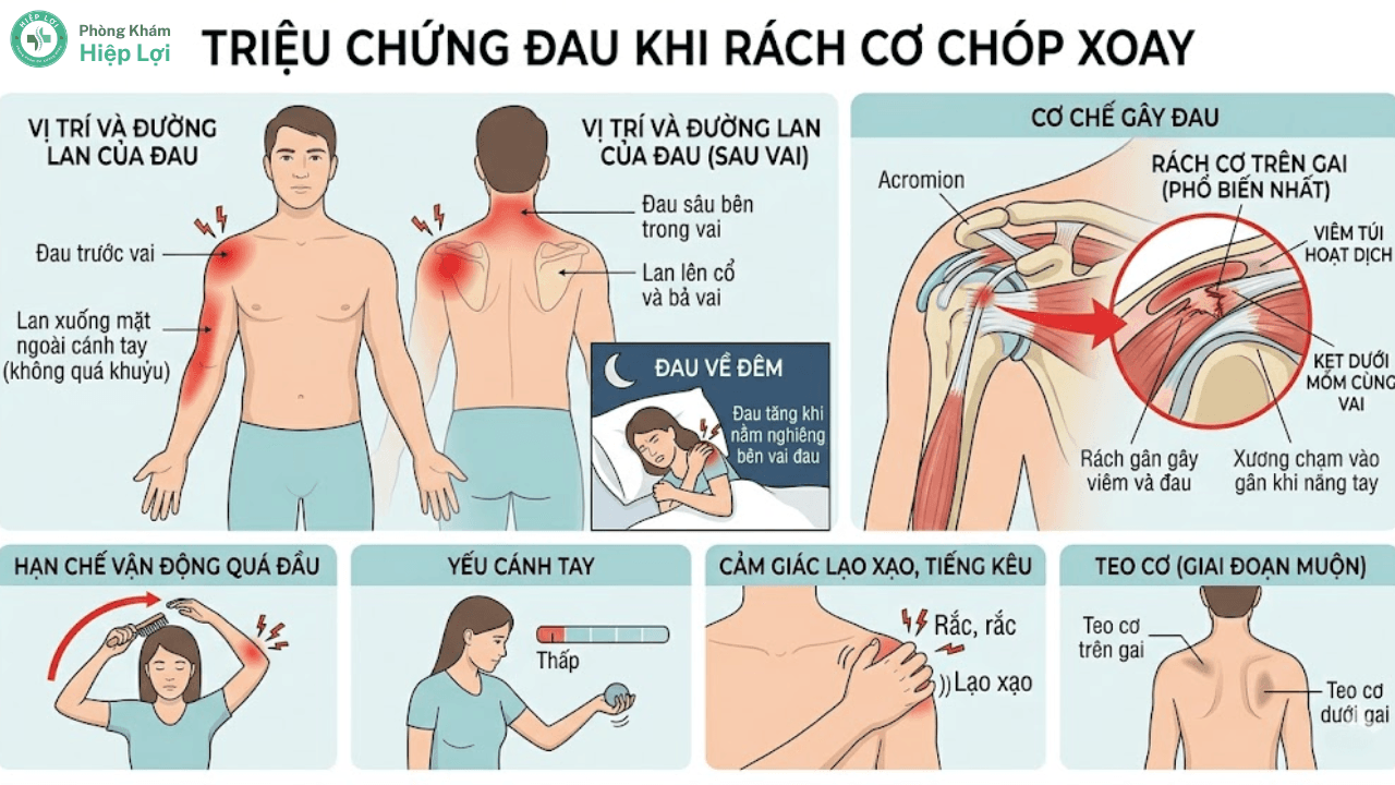 Rách Cơ Chóp Xoay Là Gì? Nguyên Nhân, Triệu Chứng Và Cách Điều Trị Hiệu Quả - Phòng khám Hiệp Lợi