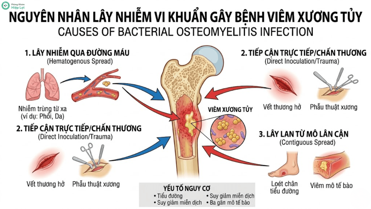 Giải Đáp Y Khoa: Bệnh Viêm Xương Tủy Có Thể Điều Trị Dứt Điểm Được Hay Không? - Phòng khám Hiệp Lợi