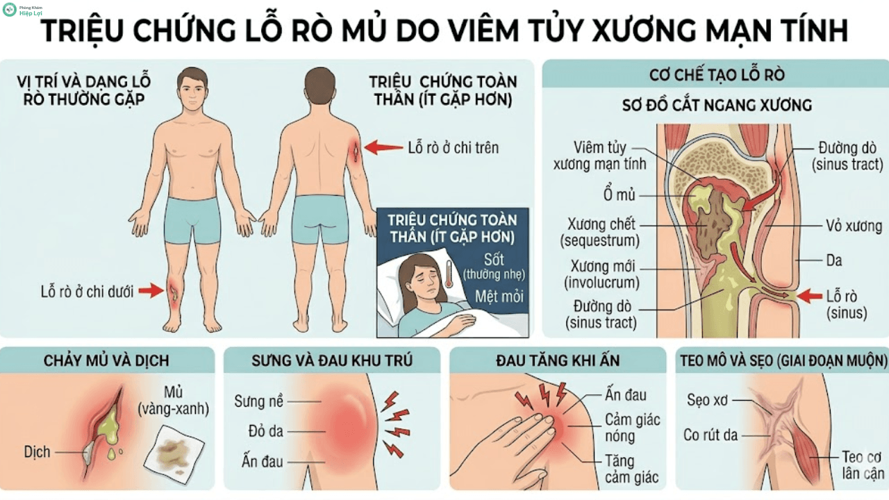 Giải Đáp Y Khoa: Bệnh Viêm Xương Tủy Có Thể Điều Trị Dứt Điểm Được Hay Không? - Phòng khám Hiệp Lợi