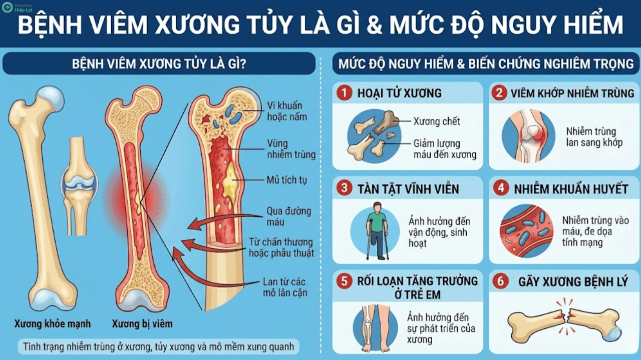 Giải Đáp Y Khoa: Bệnh Viêm Xương Tủy Có Thể Điều Trị Dứt Điểm Được Hay Không?