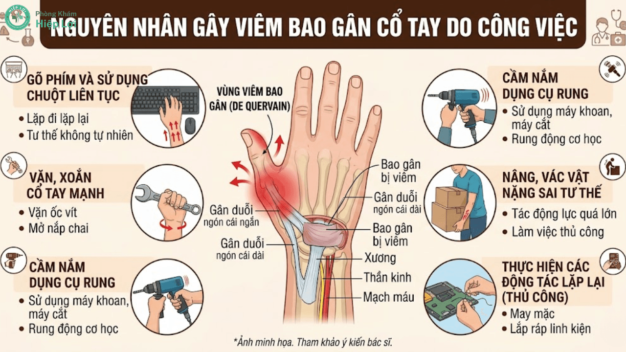 Viêm Bao Gân Cổ Tay: Nguyên Nhân, Dấu Hiệu Và Cách Điều Trị - Phòng khám Hiệp Lợi