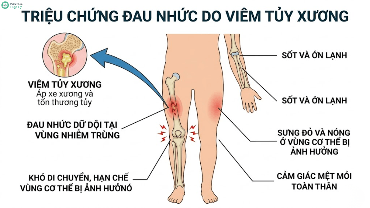 Bệnh Viêm Tủy Xương Là Gì? Triệu Chứng, Chẩn Đoán Và Cách Điều Trị - Phòng khám Hiệp Lợi