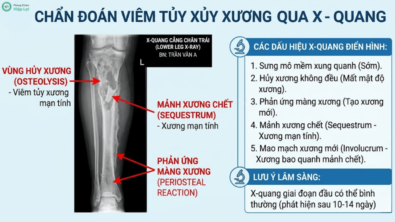 Bệnh Viêm Tủy Xương Là Gì? Triệu Chứng, Chẩn Đoán Và Cách Điều Trị - Phòng khám Hiệp Lợi