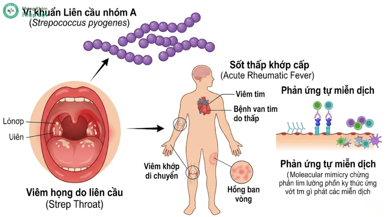 Sốt Thấp Khớp Là Gì? Tìm Hiểu Nguyên Nhân, Triệu Chứng Và Cách Chữa Trị Hiệu Quả - Phòng khám Hiệp Lợi