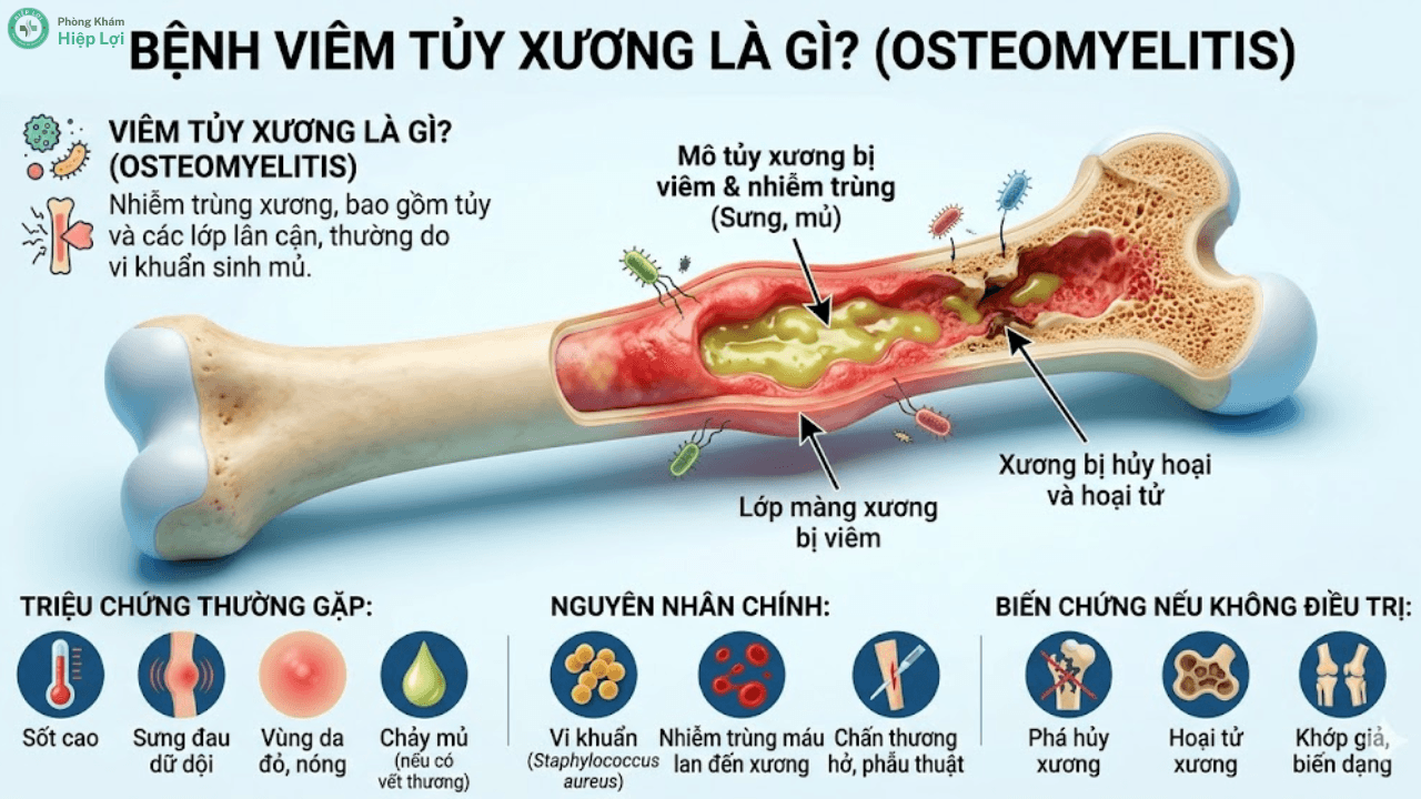 Bệnh Viêm Tủy Xương Là Gì? Triệu Chứng, Chẩn Đoán Và Cách Điều Trị