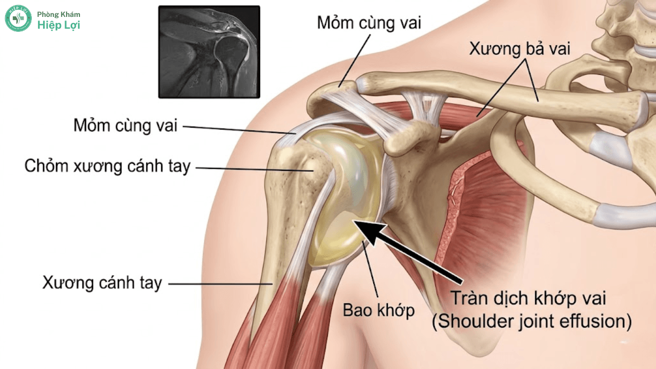 Điều Trị Và Chăm Sóc Bệnh Nhân Tràn Dịch Khớp Vai