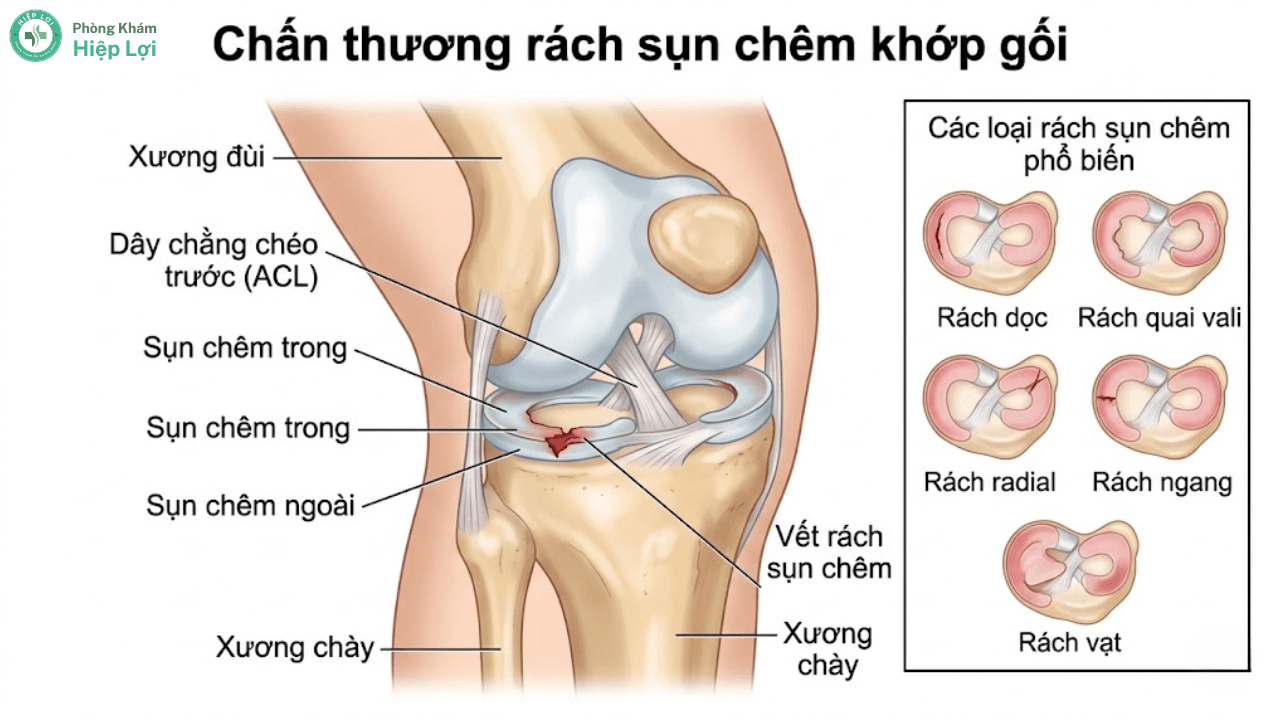 Điều Trị Rách Sụn Chêm Khớp Gối Và Phục Hồi Chức Năng