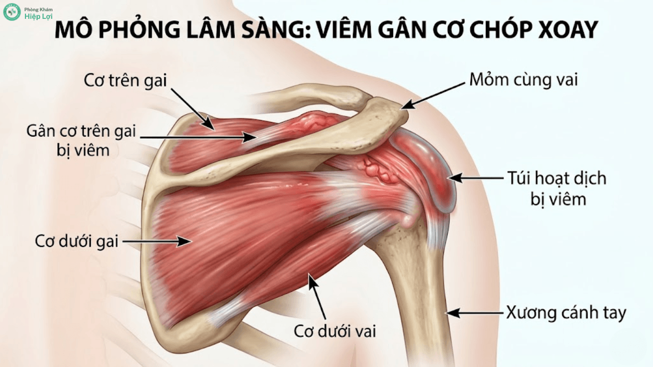 Cảnh Báo: Những Đối Tượng Nào Có Nguy Cơ Bị Viêm Quanh Khớp Vai Cao Nhất?