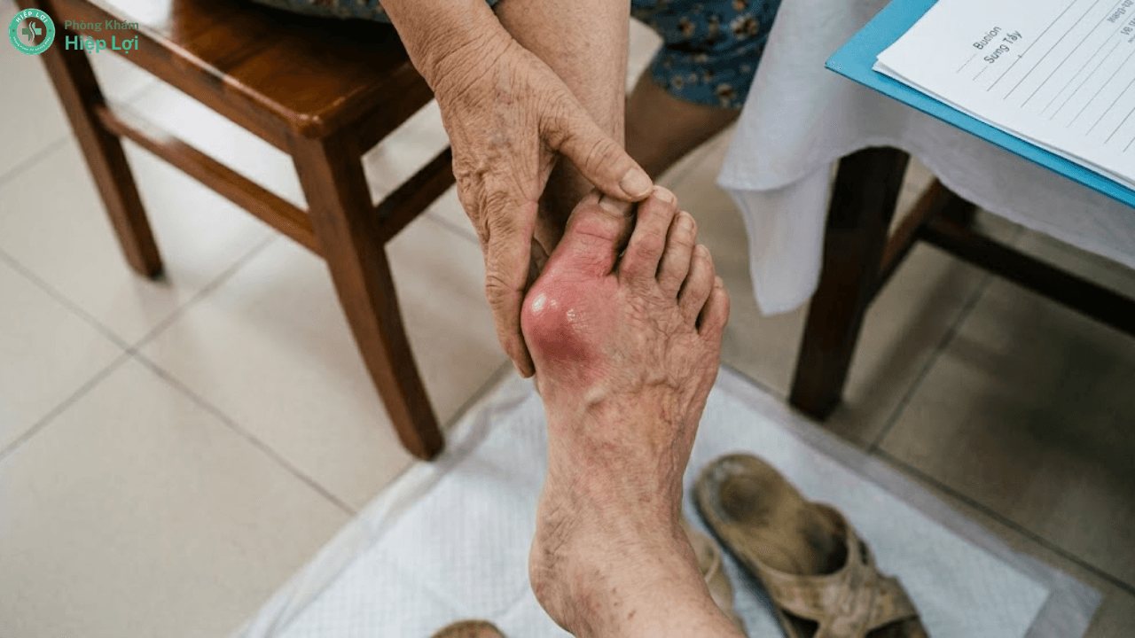 Sưng Ngón Chân Cái Và Biến Dạng Bunion: Nguyên Nhân, Triệu Chứng Và Cách Chữa Trị - Phòng khám Hiệp Lợi