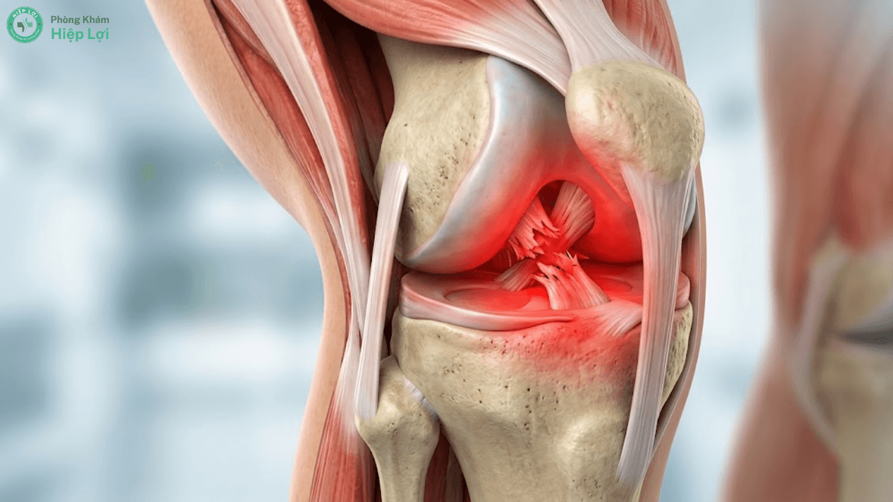 Đứt Dây Chằng Khớp Gối Có Đáng Lo Ngại Không? Nguyên Nhân, Triệu Chứng Và Cách Điều Trị - Phòng khám Hiệp Lợi